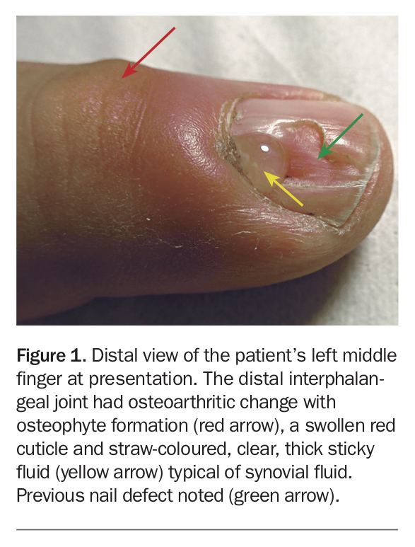 Recurring swelling on finger Medicine Today